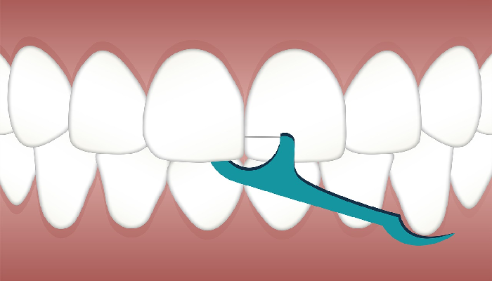 Dental crowns in san diego