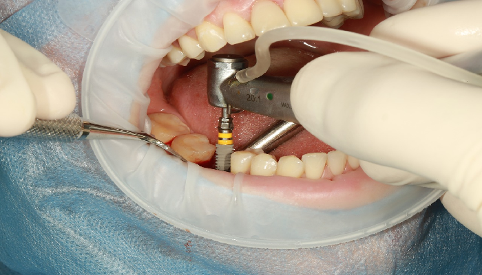 Dental implants in mission viejo ca