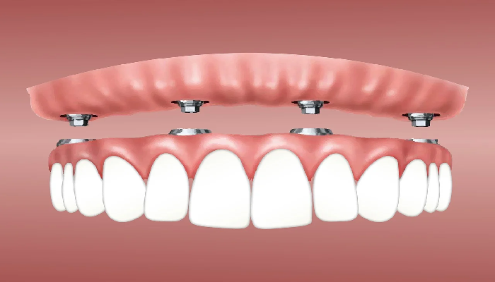 Tooth Crowns Before and After