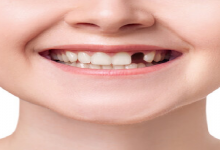 Can ifill teeth spacing or do i need braces​