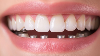 Renaissance covereage dental implants​